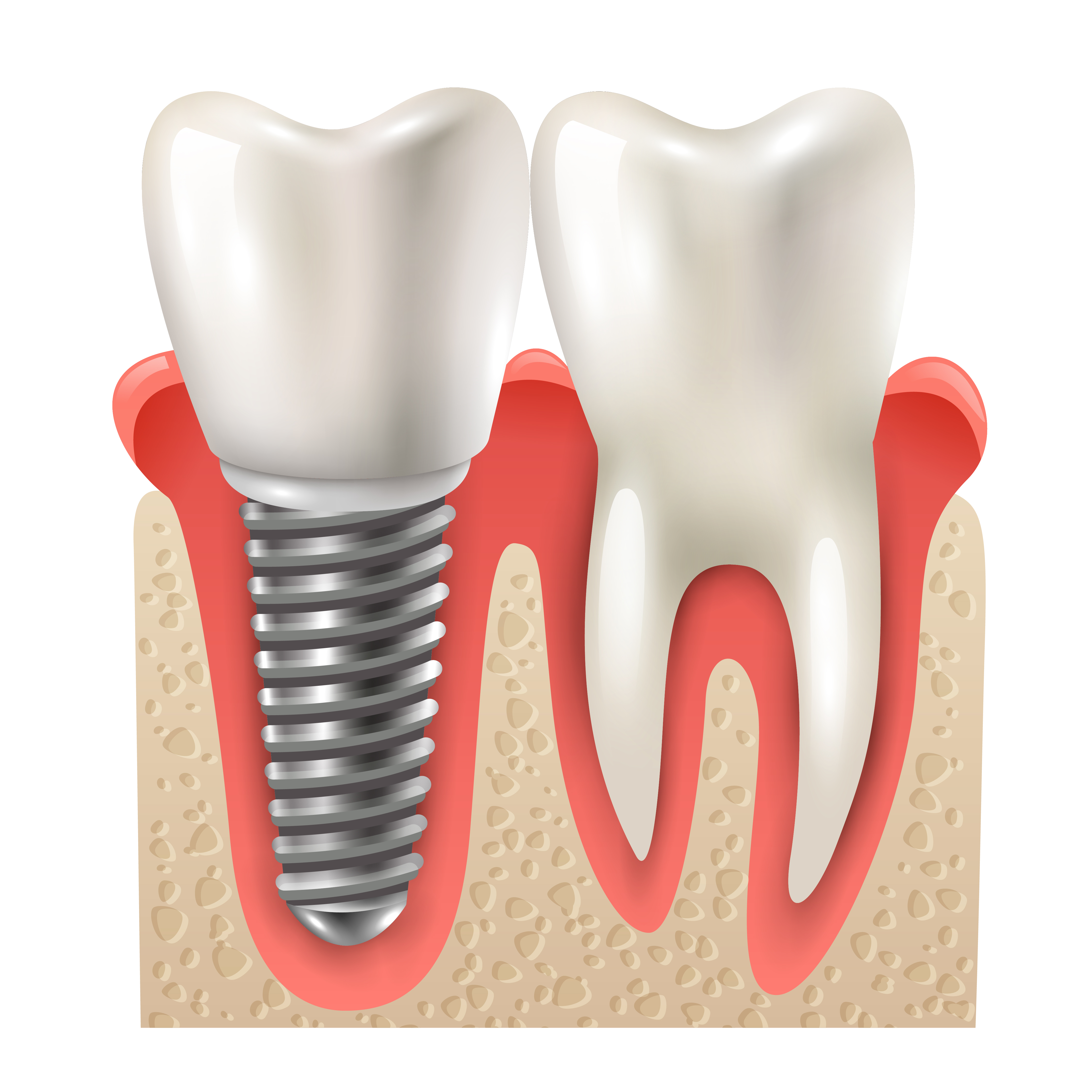 Dental Implants at Dr. Dhanshree's Dental Clinic
